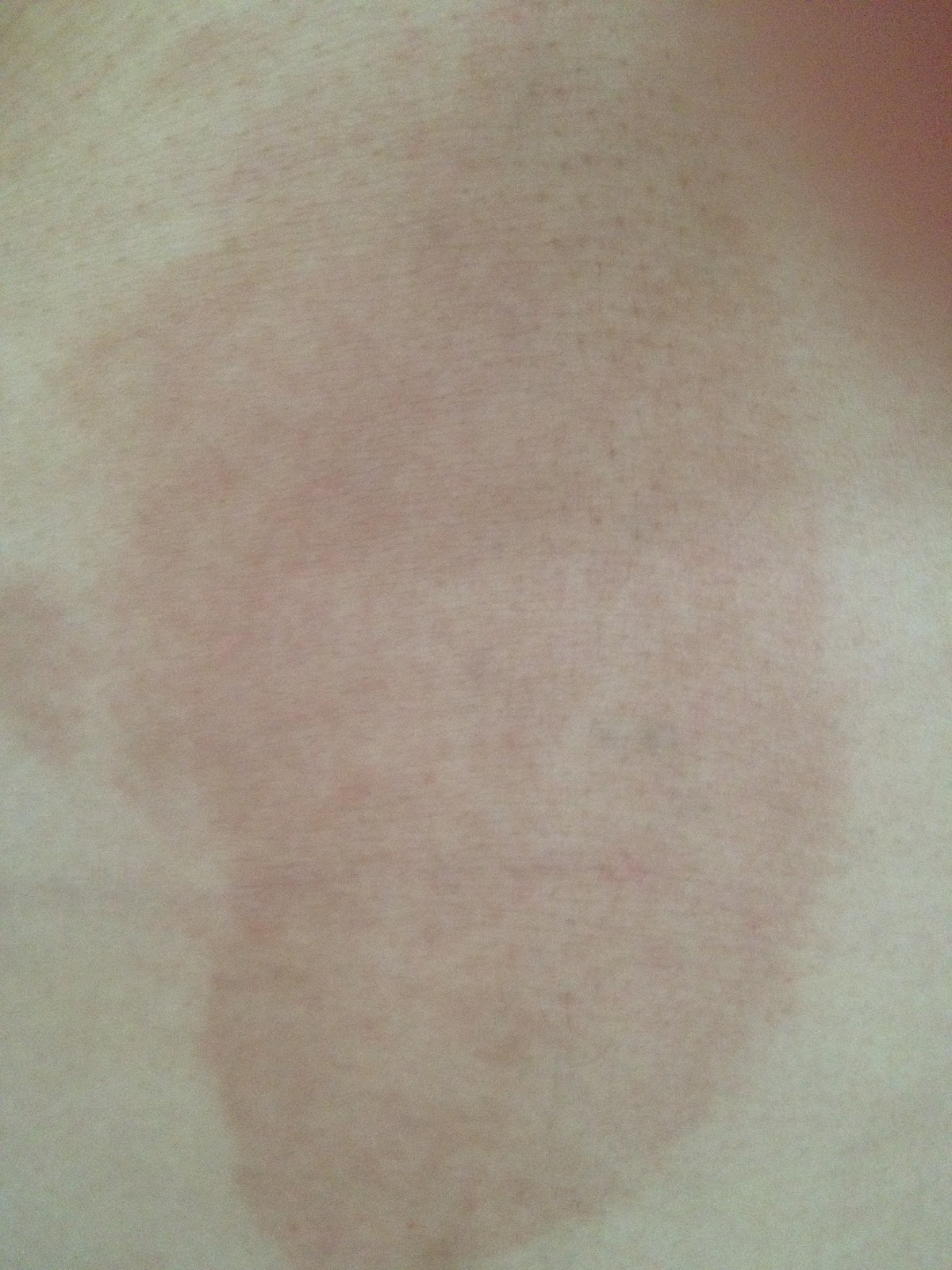 Palmer's cocoa butter. See it used on me! Do not read post if sensitive